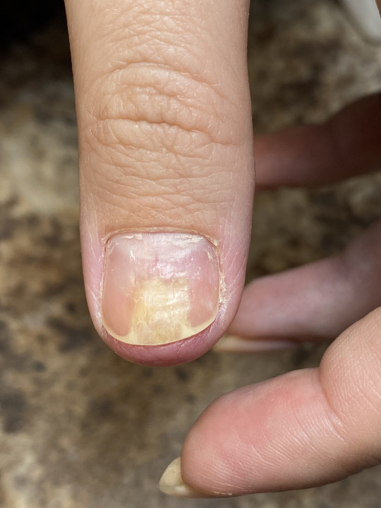 фото Отслоение ногтя от ногтевого ложе